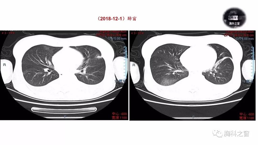 猫咪胸腔积液的原因与防治策略探讨